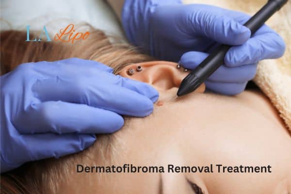 Dermatofibroma Removal Treatment Lewisham