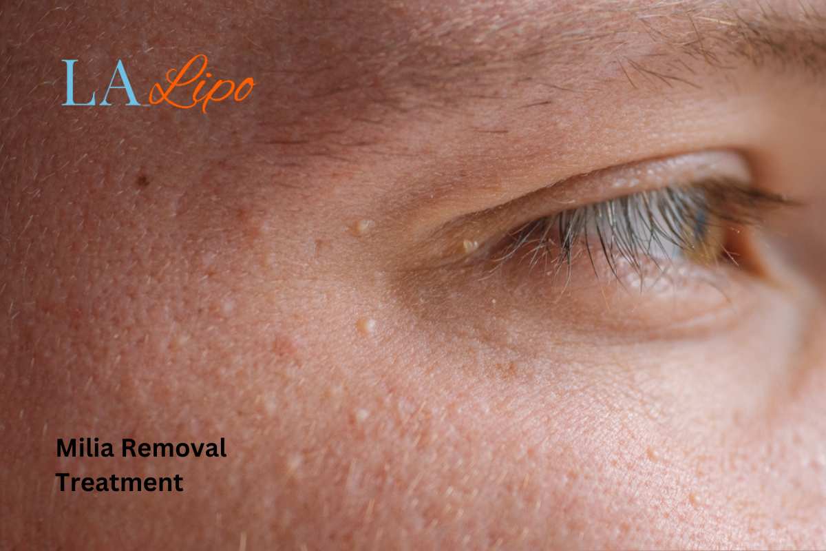 Cryopen Milia Removal: Is It the Easiest and Safest Option Lewisham?