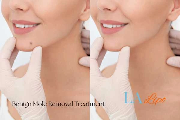 woman's before and after mole removal Lewisham results
