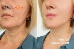 hi-fu for wrinkles Lewisham before and after results