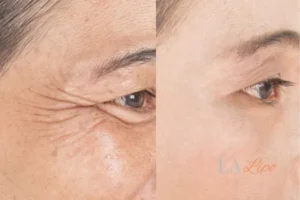 Before and after results of woman - HI-fu wrinkles reduction treatment Lewisham