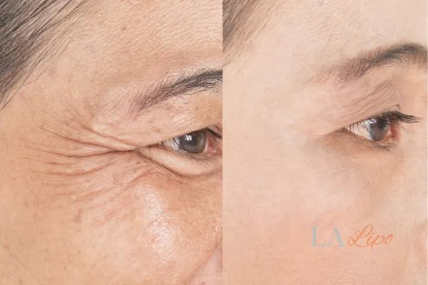 Before and after results of woman - HI-fu wrinkles reduction treatment Lewisham