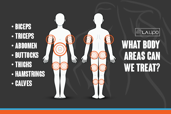 Graphic to show areas you can have LA-EMS Body Sculpting Lewisham treatment.