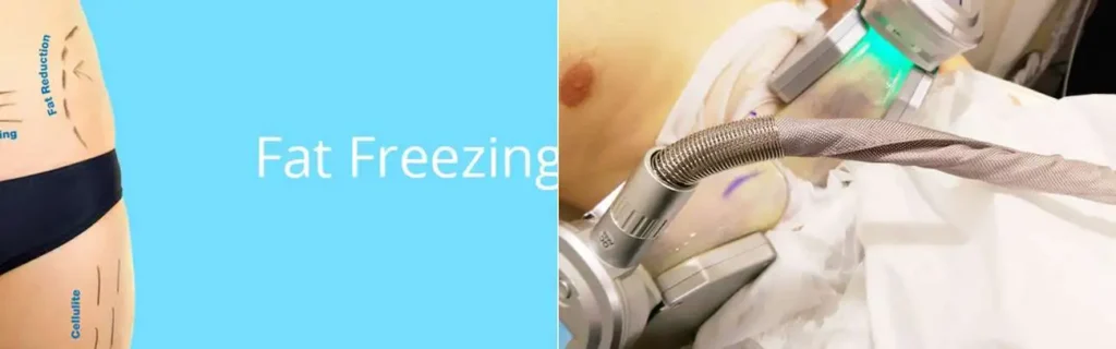 Fat freezing Lewisham on multiple areas of the body