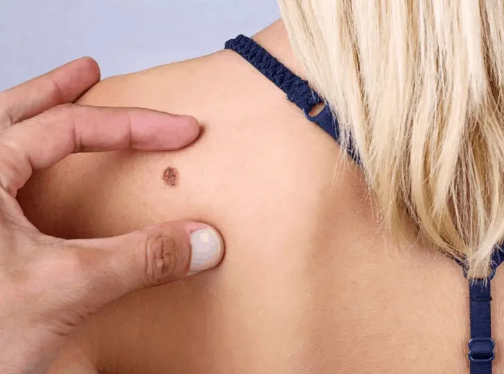 woman having mole removal Lewisham consultation before treatment.