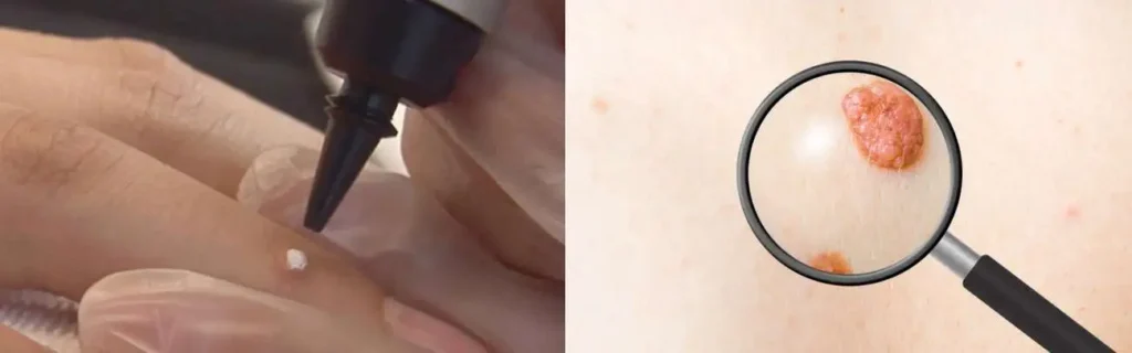 Cryopen for mole removal Lewisham - speak to our team today!