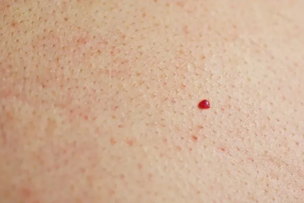 close up of a cherry angioma Lewisham