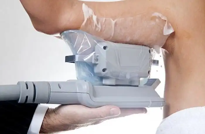 Picture of fat freezing Lewisham on the upper arms.