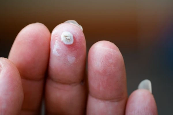 wart on person finger - cryotherapy to treat from LA LIPO Lewisham