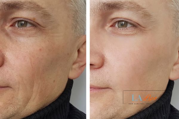 See the amazing results of Morpheus8 Treatment Lewisham!