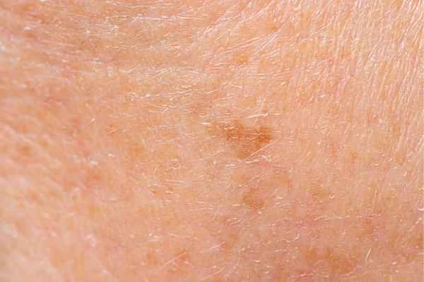 close up picture of age spots Lewisham