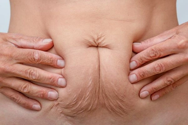 Image of a woman's stomach with loose skin - example of skin tightening Lewisham options