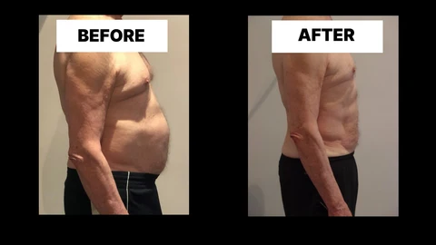 What Symptoms Can Diastasis Recti Cause in Men? Weak Core, Back Pain and Poor Posture Lewisham